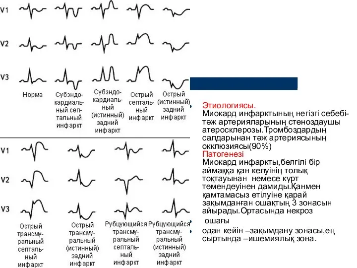 Этиологиясы. Миокард инфарктының негізгі себебі-тәж артерияларының стеноздаушы атеросклерозы.Тромбоздардың салдарынан тәж артериясының окклюзиясы(90%) Патогенезі