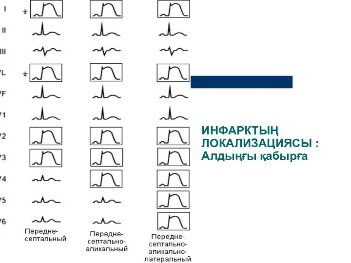 ИНФАРКТЫҢ ЛОКАЛИЗАЦИЯСЫ : Алдыңғы қабырға