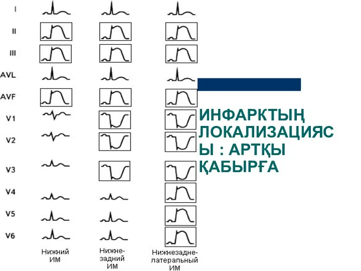 ИНФАРКТЫҢ ЛОКАЛИЗАЦИЯСЫ : АРТҚЫ ҚАБЫРҒА