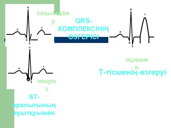 ишемия некроз зақымдану QRS-КОМПЛЕКСІНІҢ ӨЗГЕРІСІ SТ-аралығының ауытқуымен Т-тісшенің өзгеруі