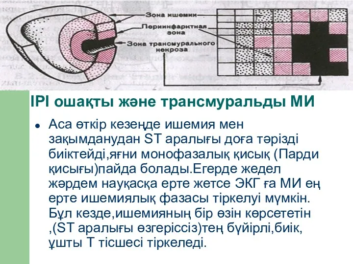 ІРІ ошақты және трансмуральды МИ Аса өткір кезеңде ишемия мен зақымданудан ST аралығы