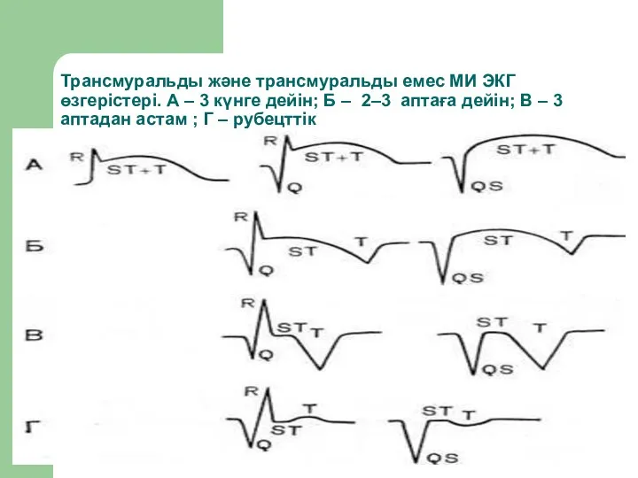 Трансмуральды және трансмуральды емес МИ ЭКГ өзгерістері. А – 3 күнге дейін; Б