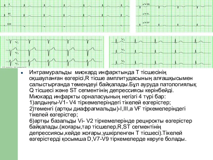 Интрамуральды миокард инфарктында Т тісшесінің оқшауланған өзгерісі,R тісше амплитудасының алғашқысымен салыстырғанда төмендеуі байқалады.Бұл