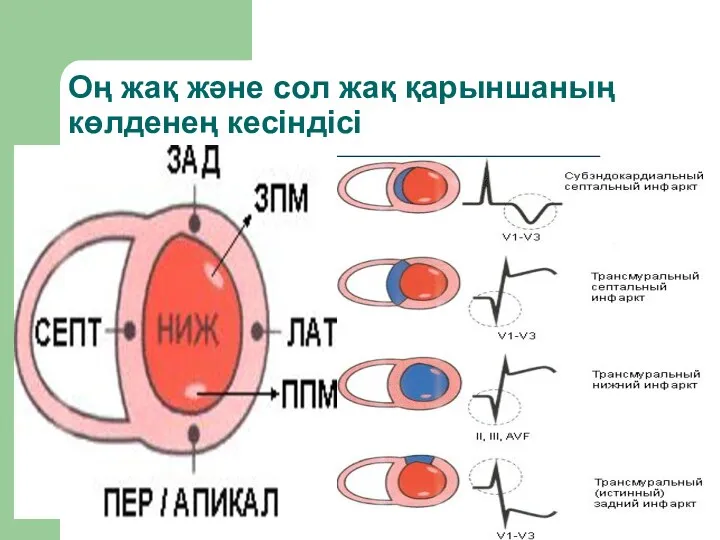 Оң жақ және сол жақ қарыншаның көлденең кесіндісі