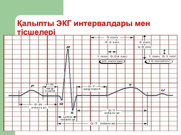 Қалыпты ЭКГ интервалдары мен тісшелері