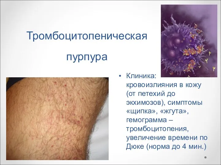 Тромбоцитопеническая пурпура Клиника: кровоизлияния в кожу (от петехий до экхимозов), симптомы «щипка», «жгута»,