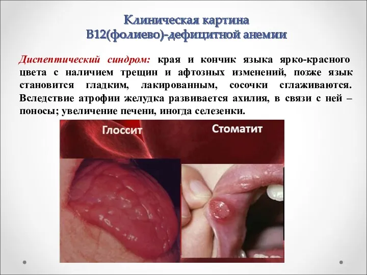 Диспептический синдром: края и кончик языка ярко-красного цвета с наличием трещин и афтозных