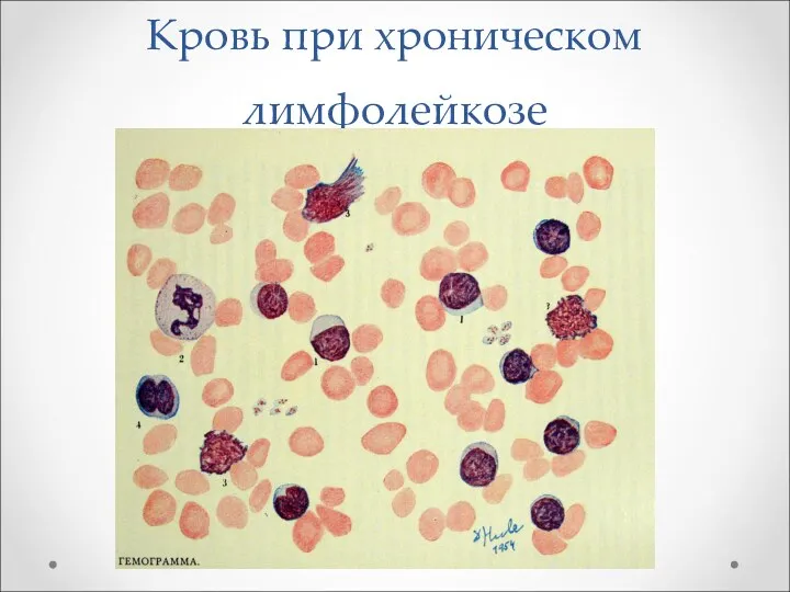 Кровь при хроническом лимфолейкозе