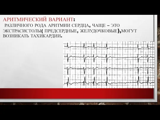 АРИТМИЧЕСКИЙ ВАРИАНТ: РАЗЛИЧНОГО РОДА АРИТМИИ СЕРДЦА, ЧАЩЕ – ЭТО ЭКСТРАСИСТОЛЫ( ПРЕДСЕРДНЫЕ, ЖЕЛУДОЧКОВЫЕ),МОГУТ ВОЗНИКАТЬ ТАХИКАРДИИ.