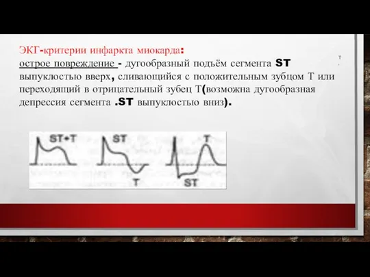 Т, ЭКГ-критерии инфаркта миокарда: острое повреждение - дугообразный подъём сегмента