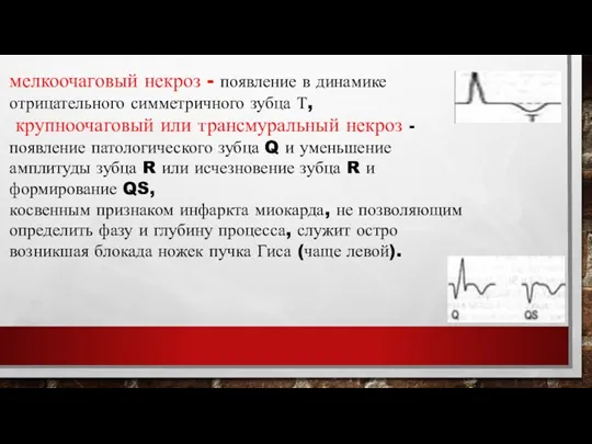 мелкоочаговый некроз - появление в динамике отрицательного симметричного зубца Т,