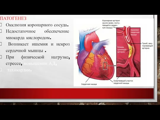 ПАТОГЕНЕЗ Окклюзия коронарного сосуда. Недостаточное обеспечение миокарда кислородом. Возникает ишемия