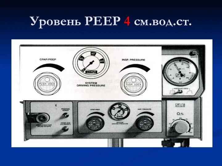 Уровень PEEP 4 см.вод.ст.