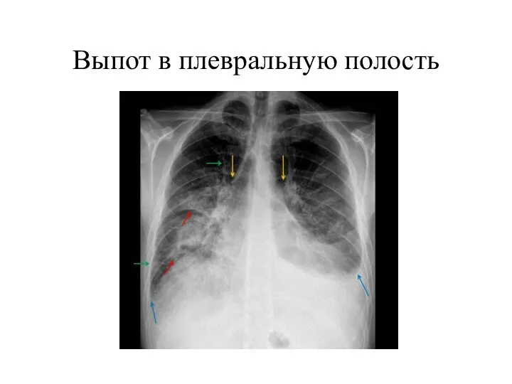 Выпот в плевральную полость