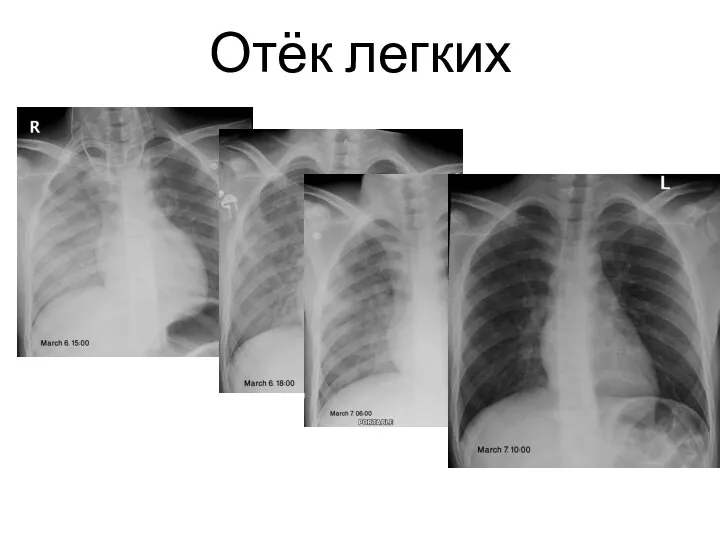 Edem pulmonar acut pe dreapta indus de laringospasm în evoluție Отёк легких