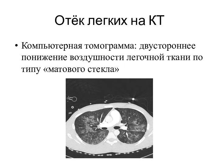 Отёк легких на КТ Компьютерная томограмма: двустороннее понижение воздушности легочной ткани по типу «матового стекла»