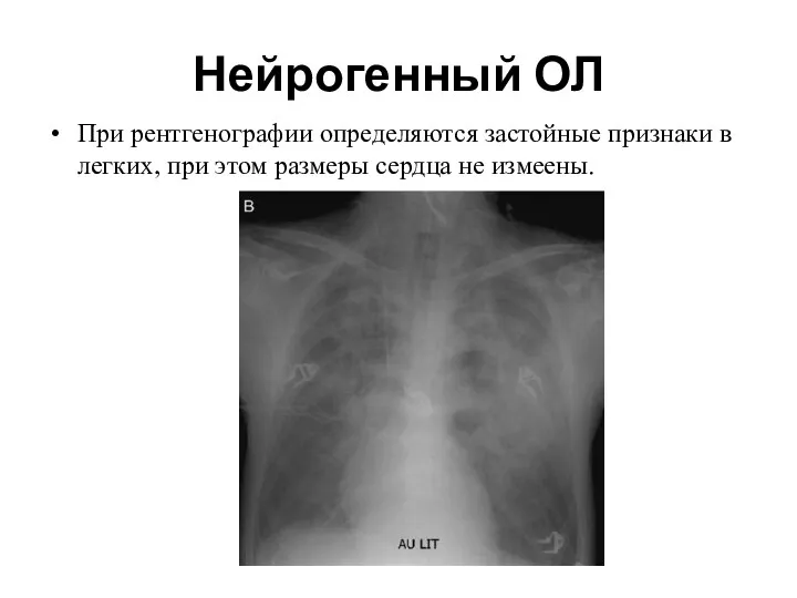 Нейрогенный ОЛ При рентгенографии определяются застойные признаки в легких, при этом размеры сердца не измеены.