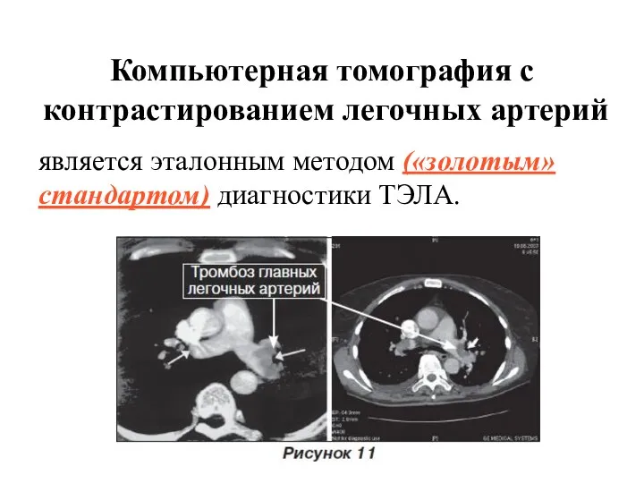 Компьютерная томография с контрастированием легочных артерий является эталонным методом («золотым» стандартом) диагностики ТЭЛА.