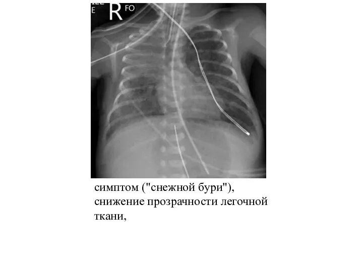 симптом ("снежной бури"), снижение прозрачности легочной ткани,