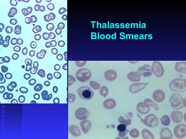 Thalassemia Blood Smears