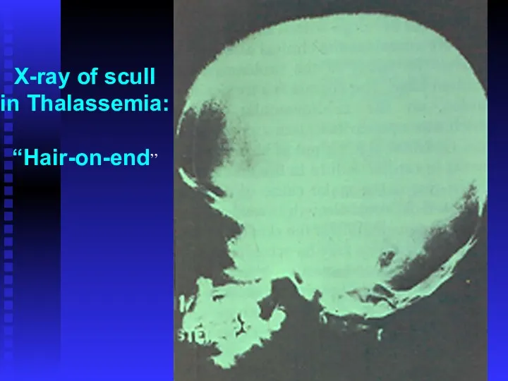 X-ray of scull in Thalassemia: “Hair-on-end”
