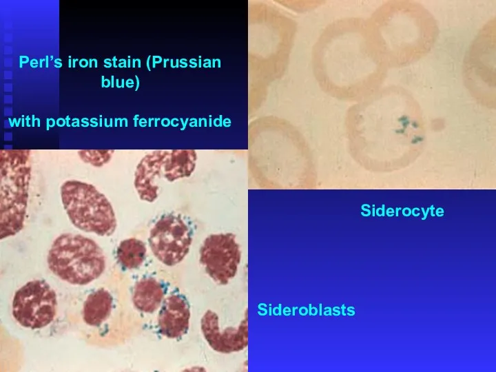 Perl’s iron stain (Prussian blue) with potassium ferrocyanide Siderocyte Sideroblasts