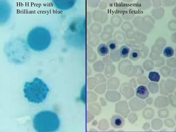 Hb H Prep with Brilliant cresyl blue α thalassemia Hydrops fetalis