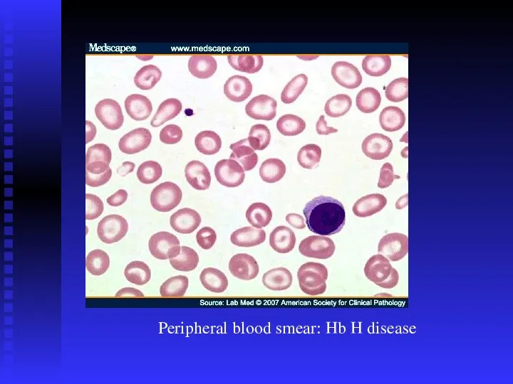 Peripheral blood smear: Hb H disease