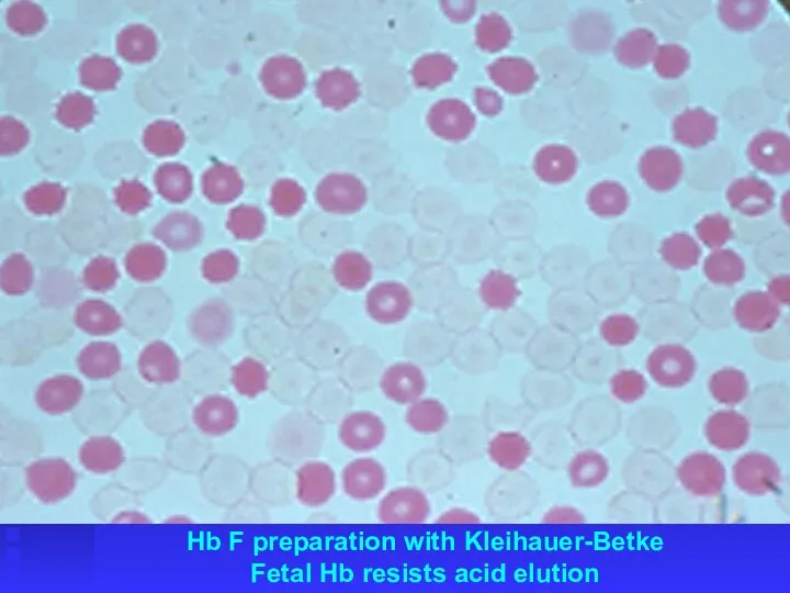 Hb F preparation with Kleihauer-Betke Fetal Hb resists acid elution