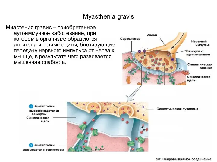 Myasthenia gravis Миастения гравис – приобретенное аутоиммунное заболевание, при котором