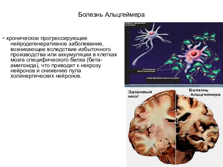 Болезнь Альцгеймера - хроническое прогрессирующее нейродегенеративное заболевание, возникающее вследствие избыточного