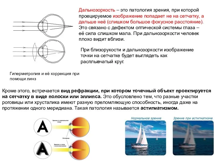 Дальнозоркость – это патология зрения, при которой проецируемое изображение попадает