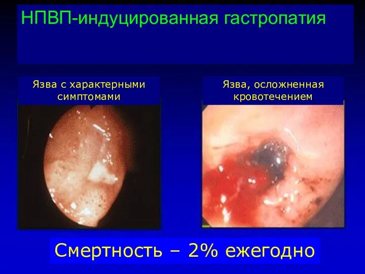 НПВП-индуцированная гастропатия Язва, осложненная кровотечением Язва с характерными симптомами Смертность – 2% ежегодно