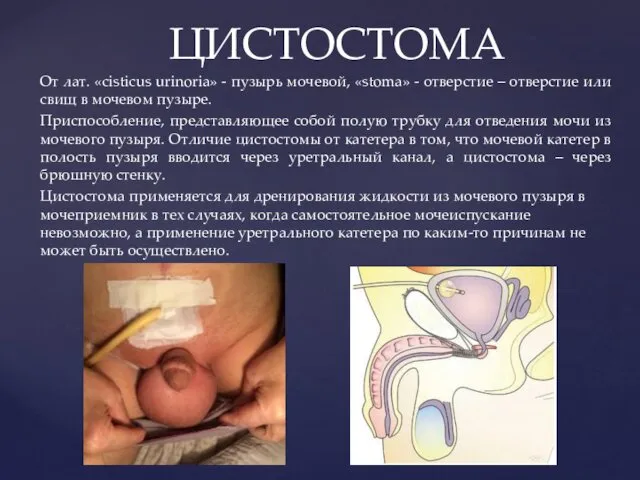 От лат. «cisticus urinoria» - пузырь мочевой, «stoma» - отверстие – отверстие или
