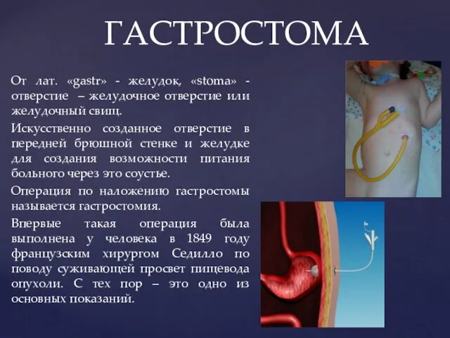 От лат. «gastr» - желудок, «stoma» - отверстие – желудочное отверстие или желудочный