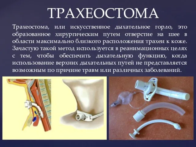 Трахеостома, или искусственное дыхательное горло, это образованное хирургическим путем отверстие на шее в