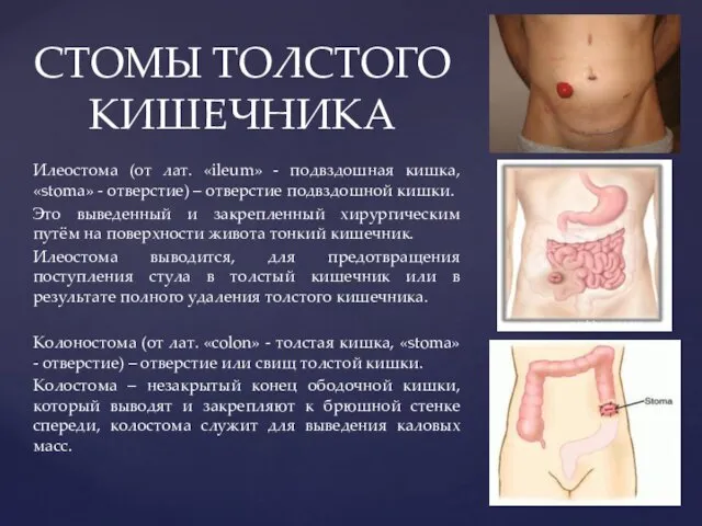 Илеостома (от лат. «ileum» - подвздошная кишка, «stoma» - отверстие)