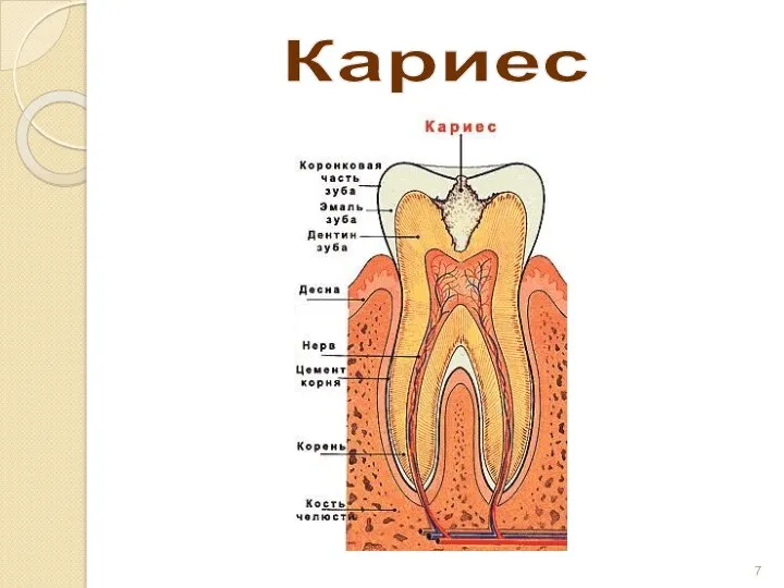 Кариес