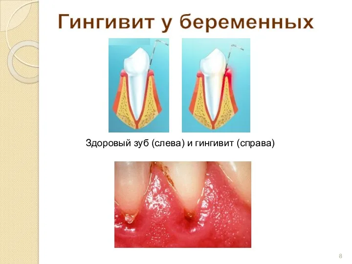 Гингивит у беременных Здоровый зуб (слева) и гингивит (справа)