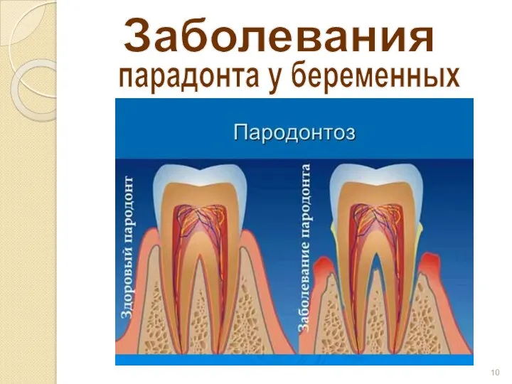 Заболевания парадонта у беременных