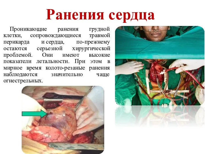 Ранения сердца Проникающие ранения грудной клетки, сопровождающиеся травмой перикарда и сердца, по-прежнему остаются