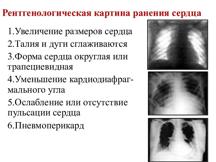 Рентгенологическая картина ранения сердца 1.Увеличение размеров сердца 2.Талия и дуги сглаживаются 3.Форма сердца