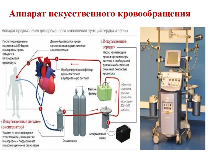 Аппарат искусственного кровообращения