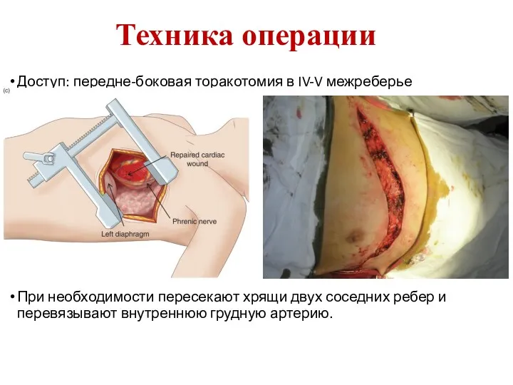 Техника операции Доступ: передне-боковая торакотомия в IV-V межреберье При необходимости пересекают хрящи двух