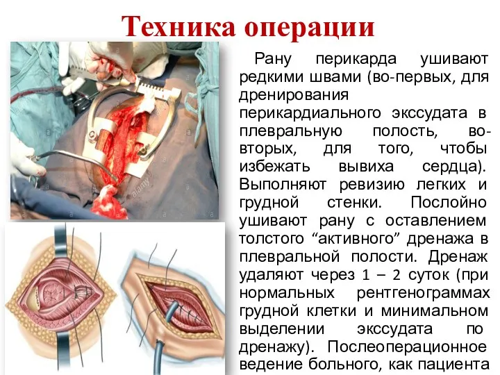 Техника операции Рану перикарда ушивают редкими швами (во-первых, для дренирования перикардиального экссудата в