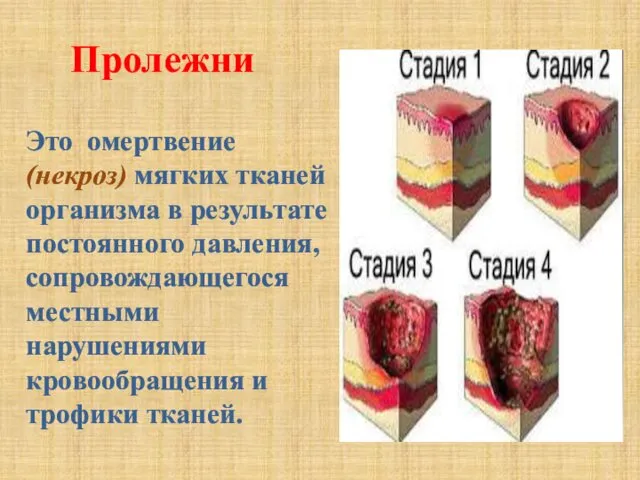 Это омертвение (некроз) мягких тканей организма в результате постоянного давления, сопровождающегося местными нарушениями