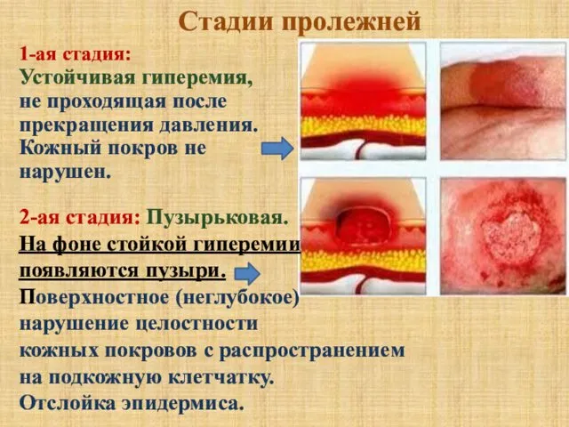 1-ая стадия: Устойчивая гиперемия, не проходящая после прекращения давления. Кожный