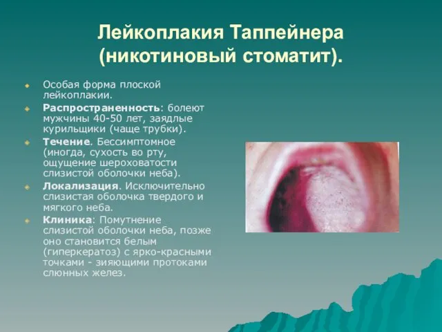 Лейкоплакия Таппейнера (никотиновый стоматит). Особая форма плоской лейкоплакии. Распространенность: болеют мужчины 40-50 лет,