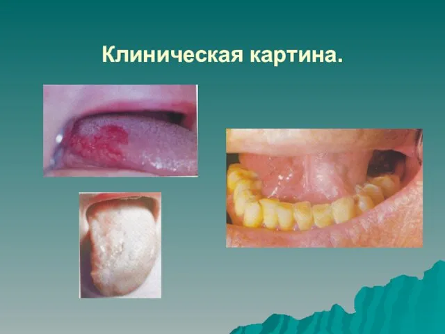 Клиническая картина.