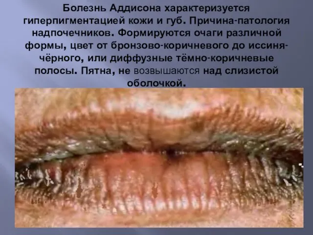 Болезнь Аддисона характеризуется гиперпигментацией кожи и губ. Причина-патология надпочечников. Формируются
